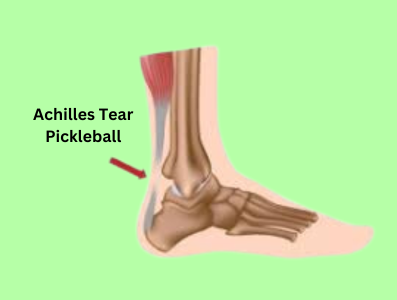 How Do You Prevent Achilles Tear Pickleball